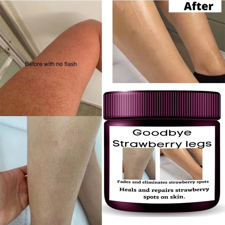 Strawberry Legs Cream Fades Strawberry Spots All Over Skin Smooth Strawberry Legs Exfoliating Cream