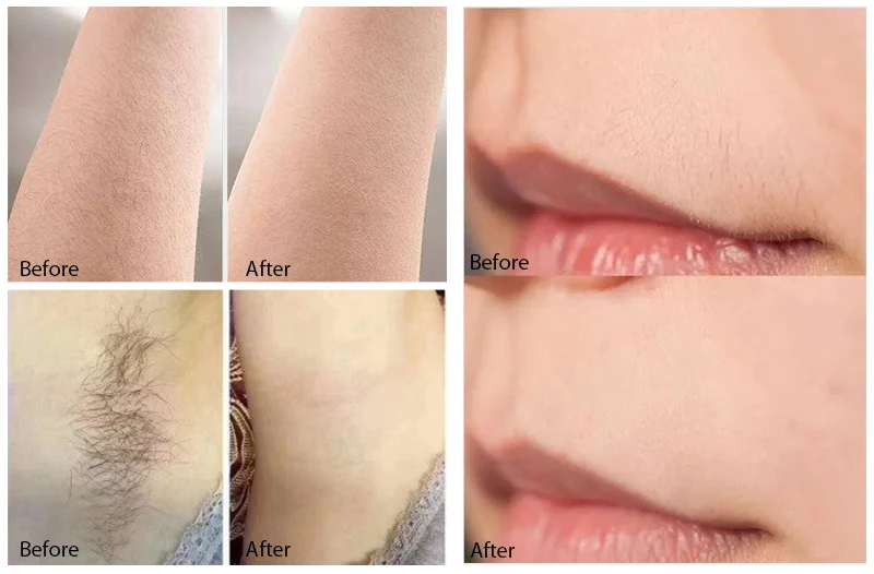 Diode laser bikini laser hair removal alexandrite ice device beauty 808 755 1064 laser removal machine