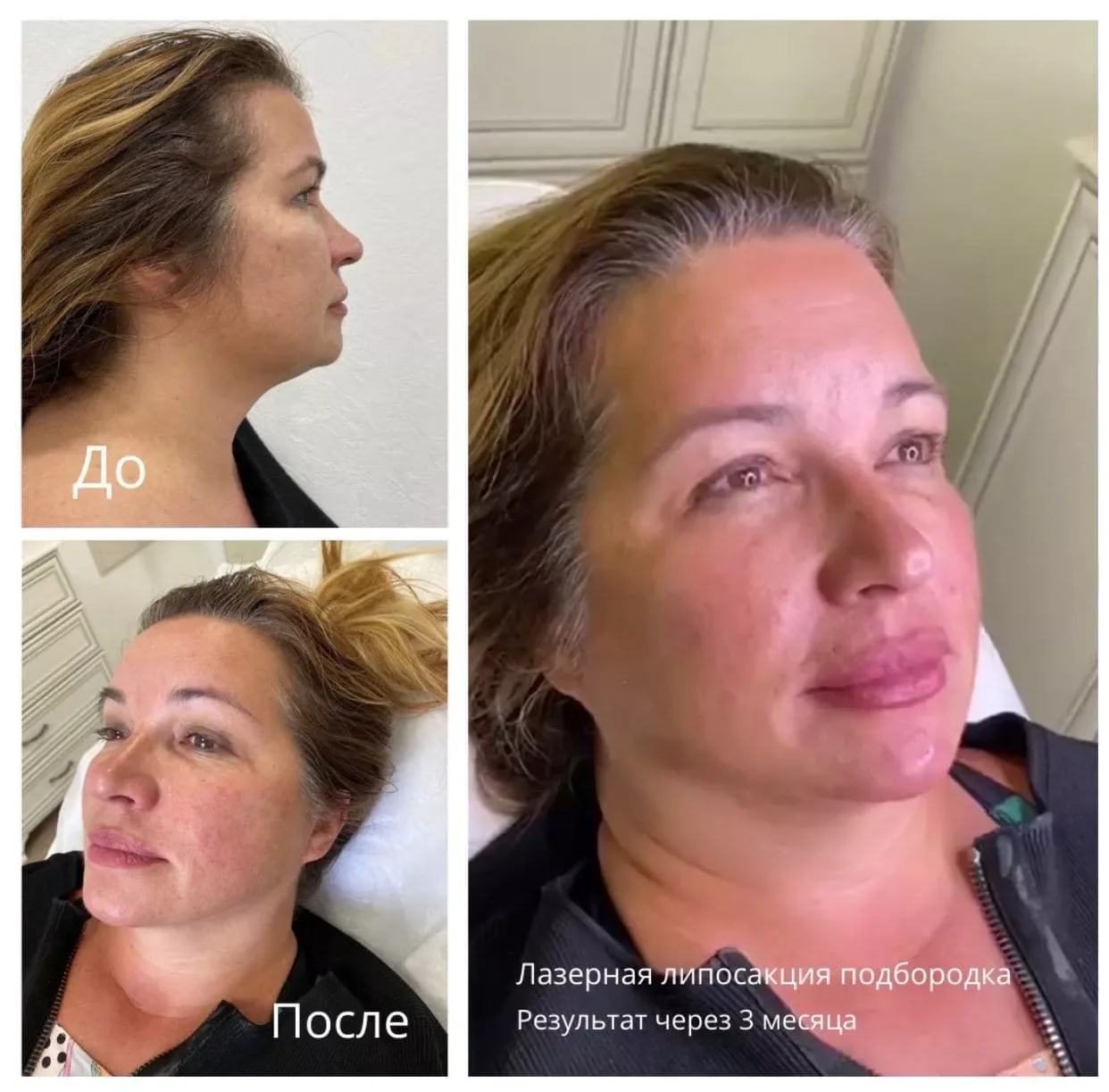 980nnm Professional Laser Liposuction Device Lipo Surgical Laser Device Endolaser face lift Laser For Body Shaping