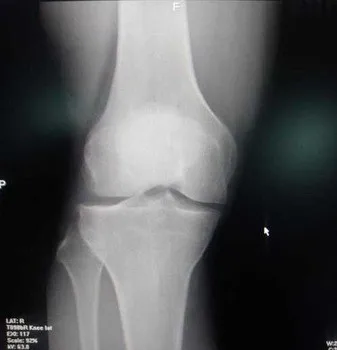 14x17 fuji medical x-ray film for fuji cr