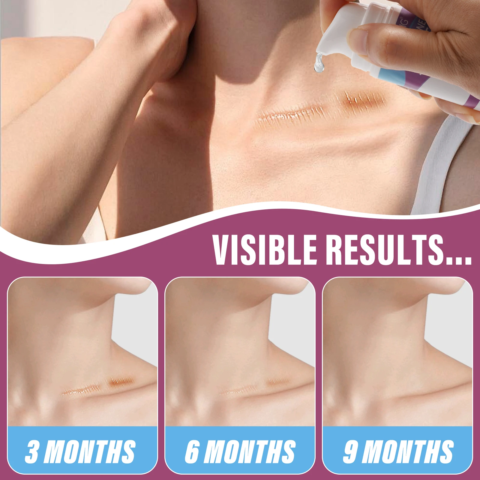 Best Selling Skin Care Scar Removal Gel Premium Face Body Pimples Acne Remove Scar Remover Gel for All Scar Type