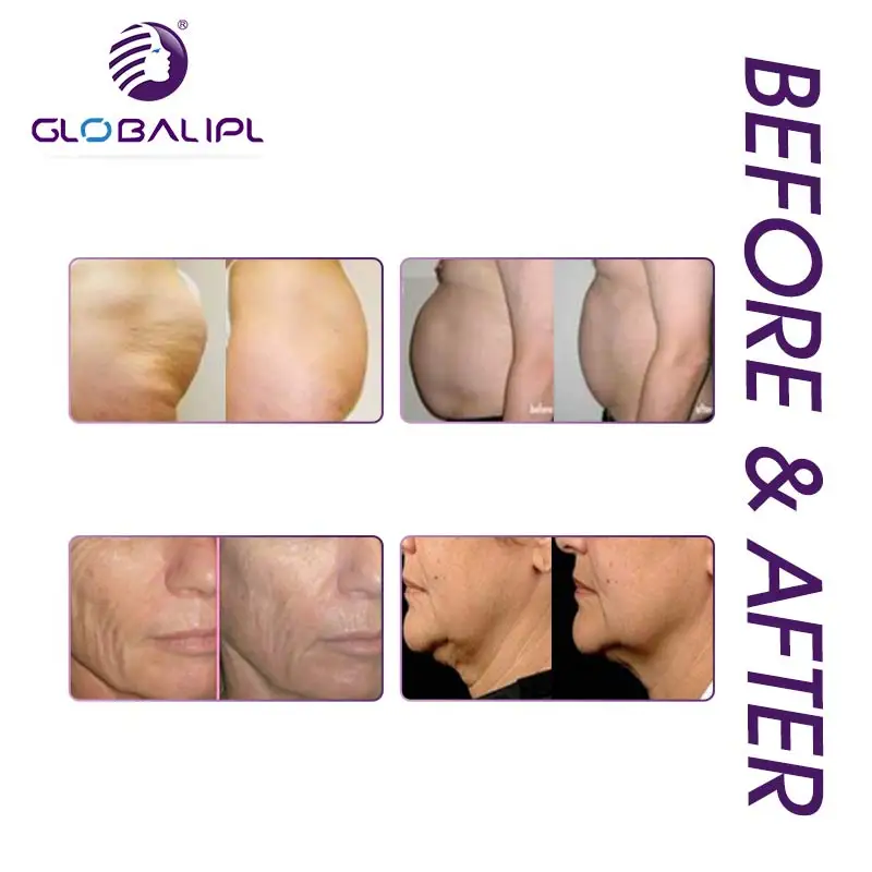 
Latest 4D system HIFU anti-wrinkle beauty machine for skin tightening 