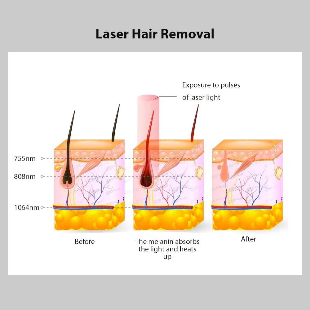 Professional diode laser hair removal system near me machine