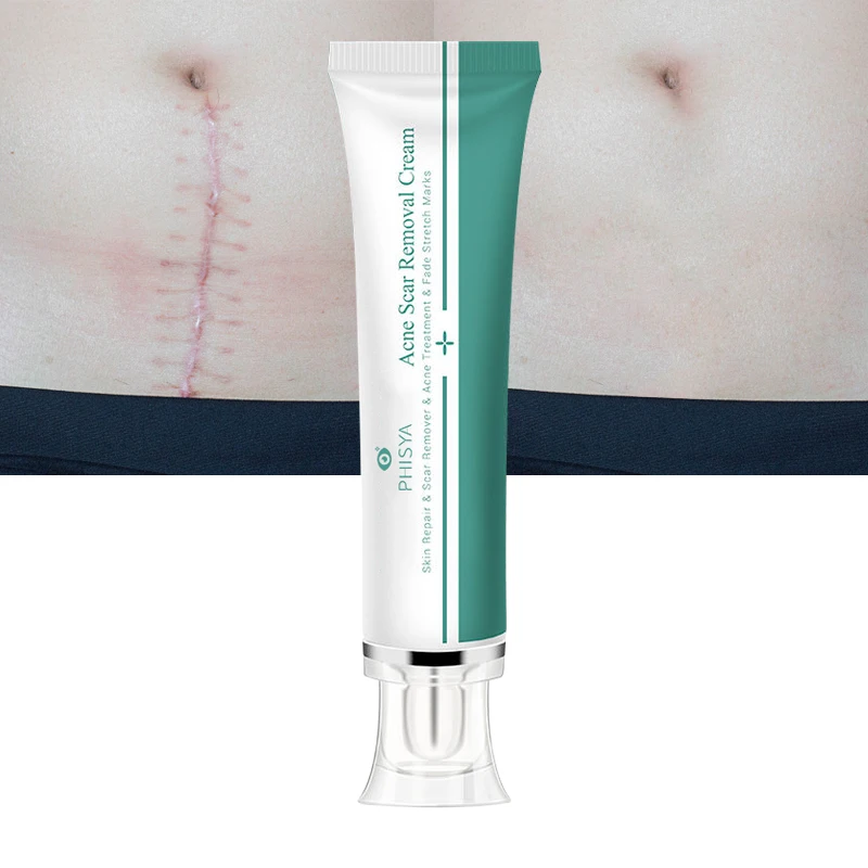Fades Scar Surgical Scars Treatment Cream Face Pimples Stretch Marks Remove Gel Effective Acne Scar Removal Cream