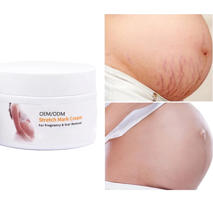 free shipping  stretch marks removal cream all skin stretch mark cream thailand quick and fastest cream for stretch marks