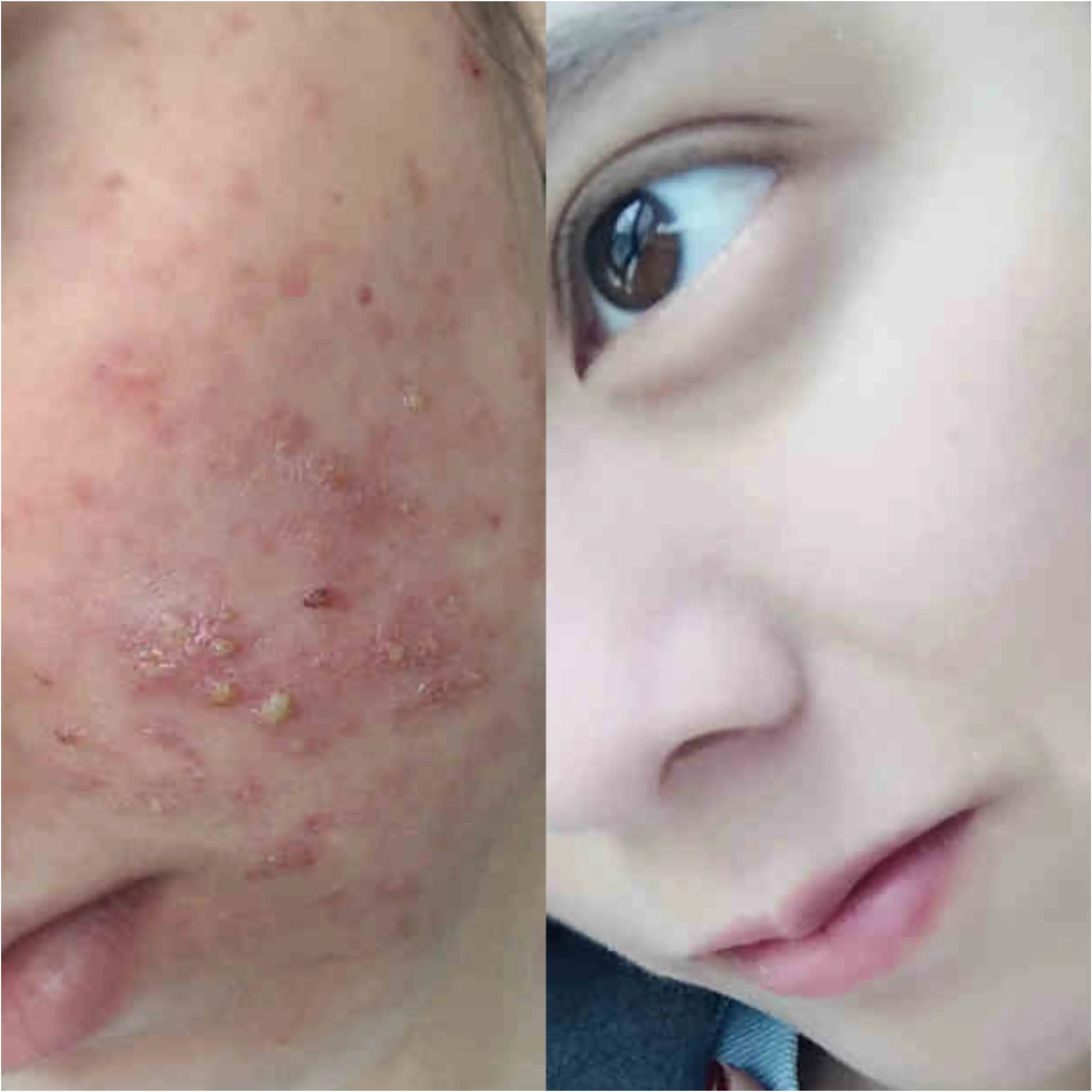 OEM ODM Acne Removal Face Cleanser Hyaluronic Acid And Nicotinamide Foaming Face Wash