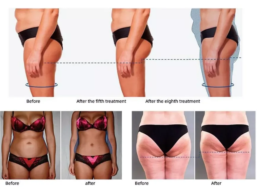 Beauty Equipment Venus Legacy Slimming Machine Skin Firming Device Tri Rf Face Lift Machine Venus Legacy Cellulite Reduction