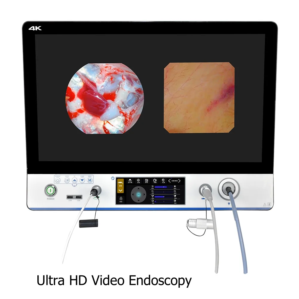 Portable medical UHD endoscope system, check all-in-one otolaryngology endoscopic surgery with a 24-inch monitor