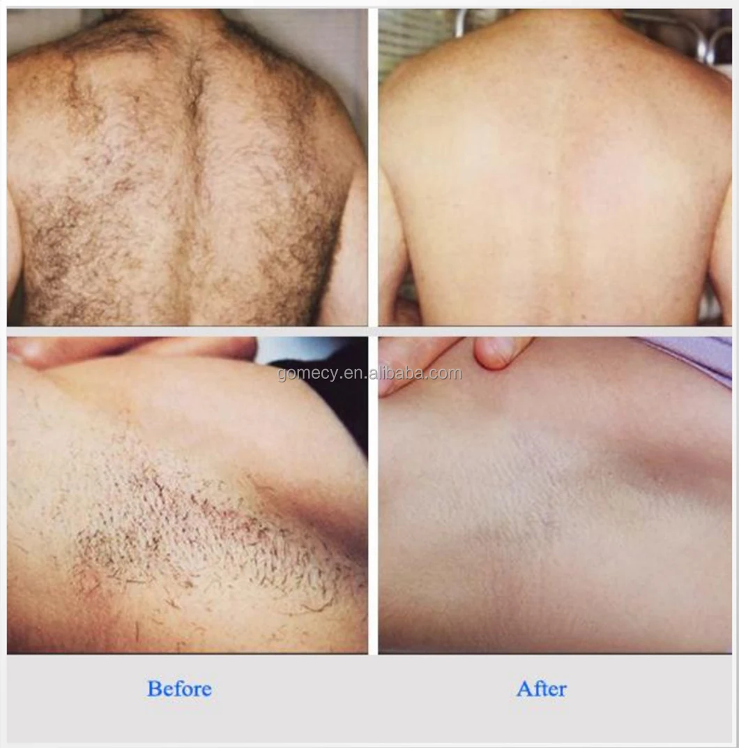 Four-Wavelength-Portable-Permanent-Hair-Removal-Machine-Newest-940nm-Diode-Laser- From-GOMECY-Factory-Price