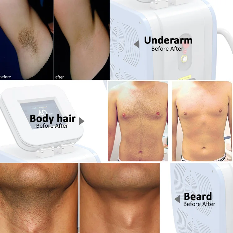 
KES Body hair remover epilator/dental diode laser/hair loss treatment equipment 