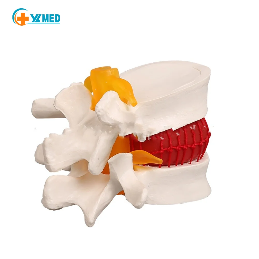 Человеческий Поясничный диск герниация демонстрационная модель анатомии обучающая диска патология анатомия