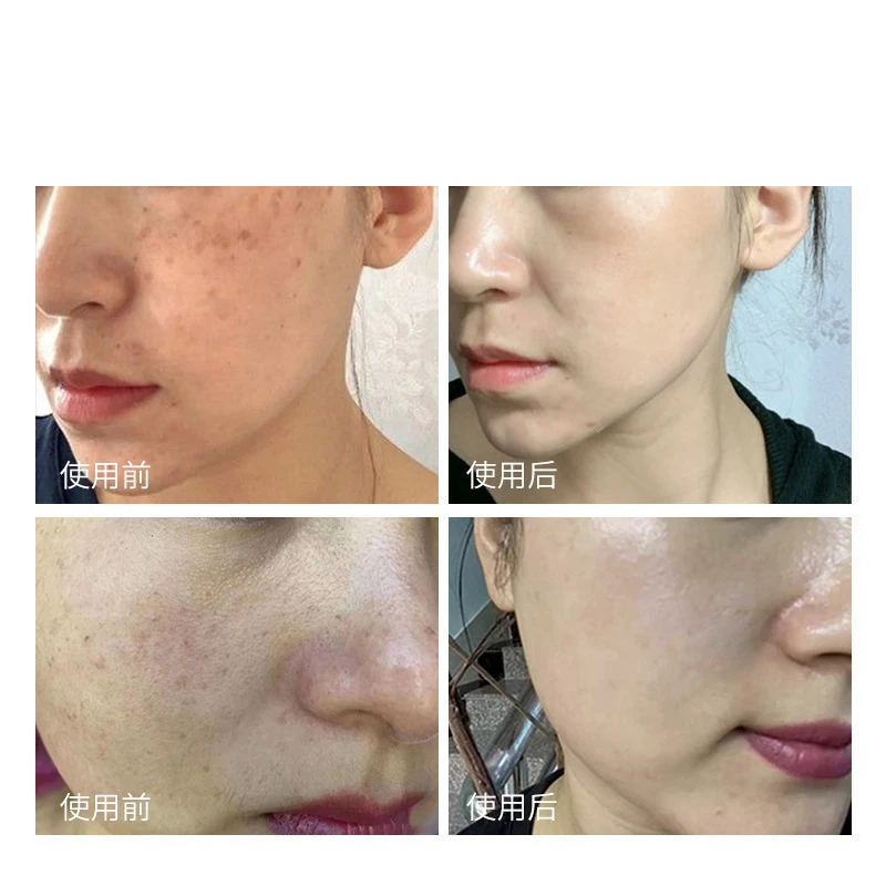 Sparse base water stinky water discharge lead and mercury to improve hormone face sensitive muscle light spot stinky water beaut