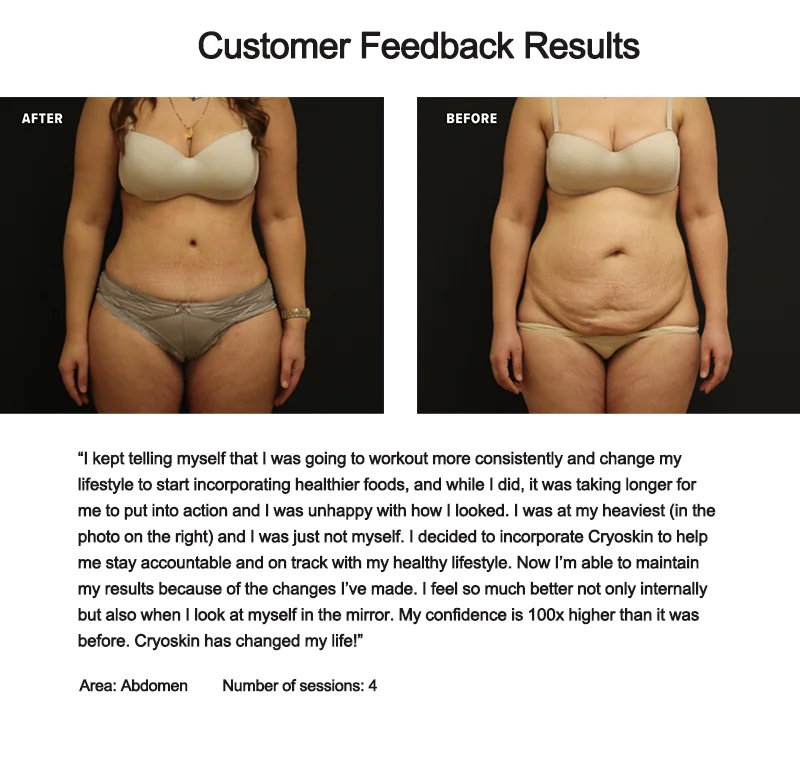 Best Selling EMS Cryoskin Body Shaping Fat Burning Cellulite Reduce Slimming Machine With 2 Round Handles and 2 Square Handles