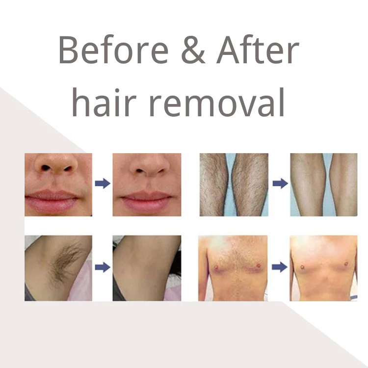 1200w Big Power 3 Waves Laser Removal Hair Tattoo Removal Machine Nd Yag Laser