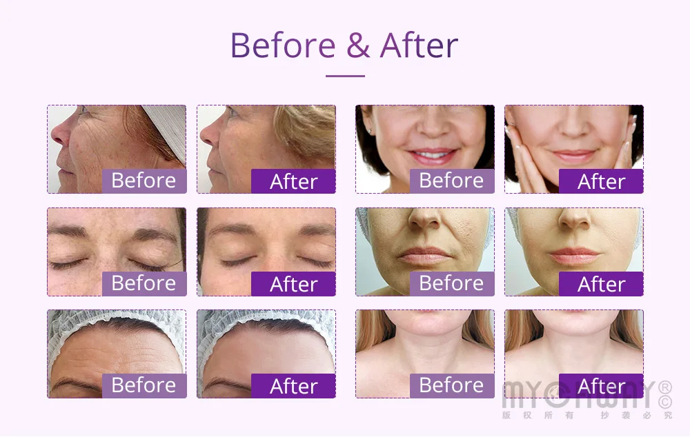 40K Cavisation Vacuum 3D RF Photon Micro Current Face & Body Slimming 7 in 1 Cavisation Machine
