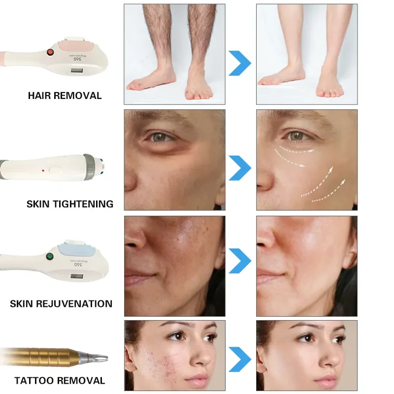 4 в 1 OPT + IPL Rf Nd YAG Перманентный лазер для удаления татуировок омоложение кожи электролизная эпиляция