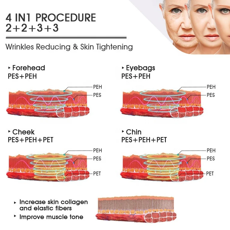 Professional non-invasively Radio Frequency Skin Lift Rf Ems Release Neck Muscles Eyes Lifting Anti-Aging Machine