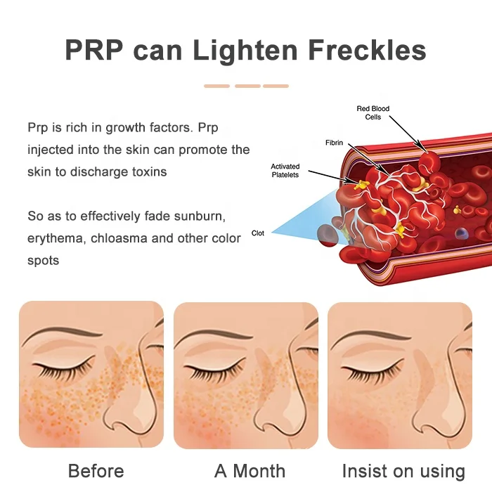 LONGTIME Medical Platelet Rich Plasma Glass Tube PRP Kit for sale
