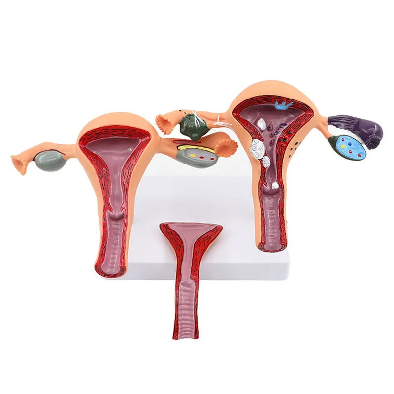 Female Plastic  Uterus Ovary Anatomical Model Vagina Model Normal/diseased Uterus Model