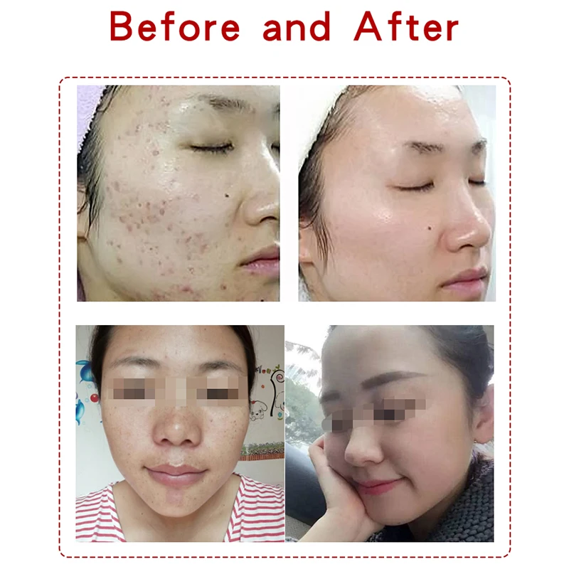 High Quality Nd Yag Laser 532/1064  PicoLaser Picosecond Laser tattoo removal machine 755nm laser picosecond