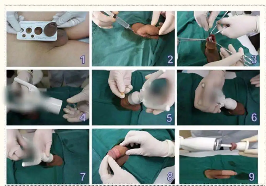 disposable circumcision stapler urology