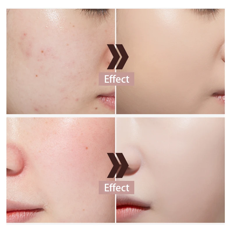 
Reduce Pores, Moisturize, Remove Acne, Fruit Acid Pore Reduction Serum Regular Size All Skin Types Liquid Face Female 