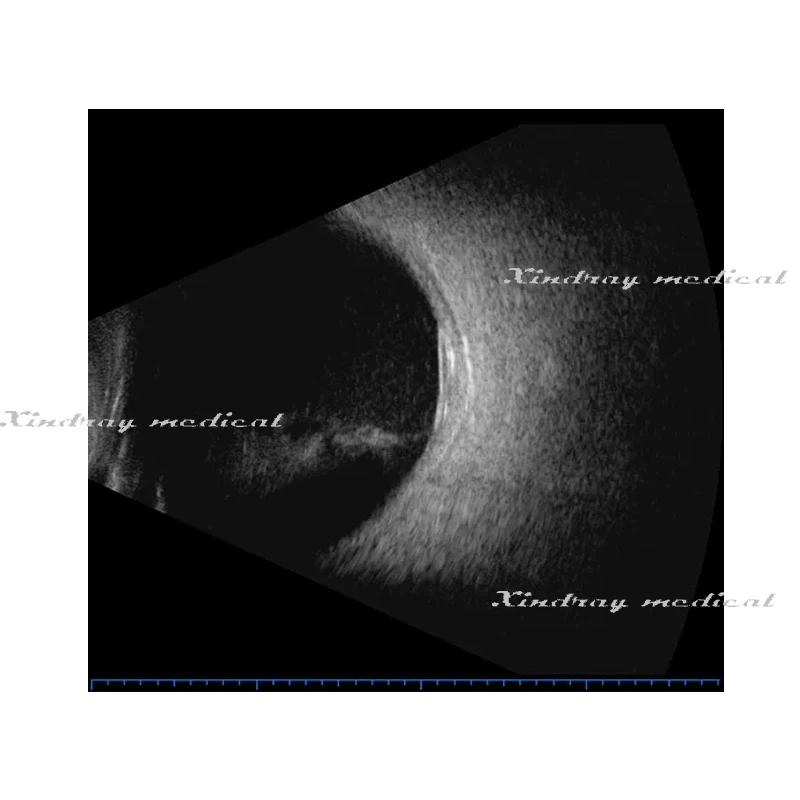 Sp-2000 Ophthalmology Ocular Test Device Ophthalmic Ultrasound Ab a B Scan for Eye Diagnosis