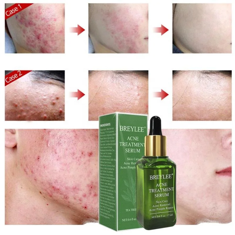 BREYLEE 17ml Herbal Organic Skin Care Serum Acne Treatment Essence Liquid Shrink Pores Repair Serum