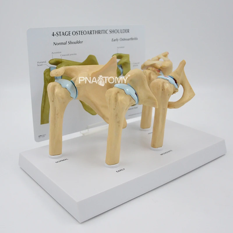 4-STAGE OSTEOARTHRITIS (OA) SHOULDER ANATOMY MODEL HUMAN SKELETON ANATOMICAL MODEL TEACHING RESOURCES EDUCATIONAL EQUIPMENT