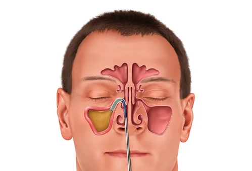 Coronado Brand ISO Approved Disposable Medical Balloon Sinuplasty System Manufacturer