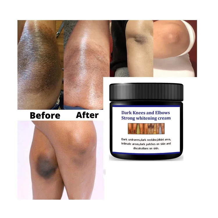 Best Selling Dark Spot Corrector Remover Private Label Skin Care Serum Whitening Freckle Bleaching Cream for Dark Skin