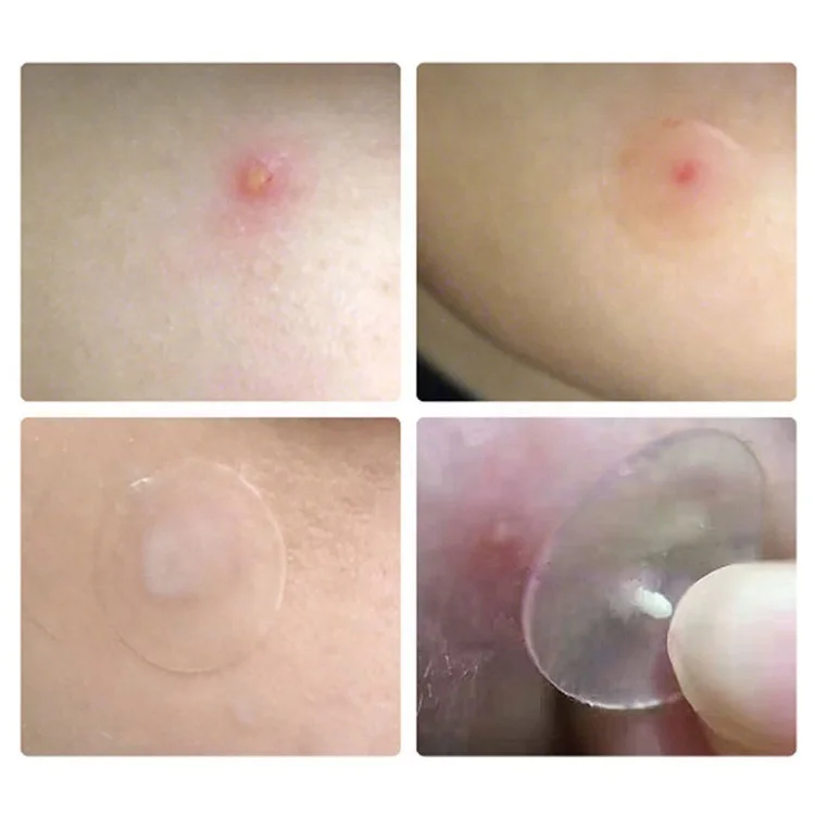 
Hot Selling Skincare Products Custom Acne Pimple Master Patch Acne Patch Private Label Acne Cover Patch 