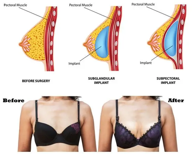 
Aoma trading Products Somed breast filer 10ml hyaluronic acid filler injection Buttock Breast Pump 