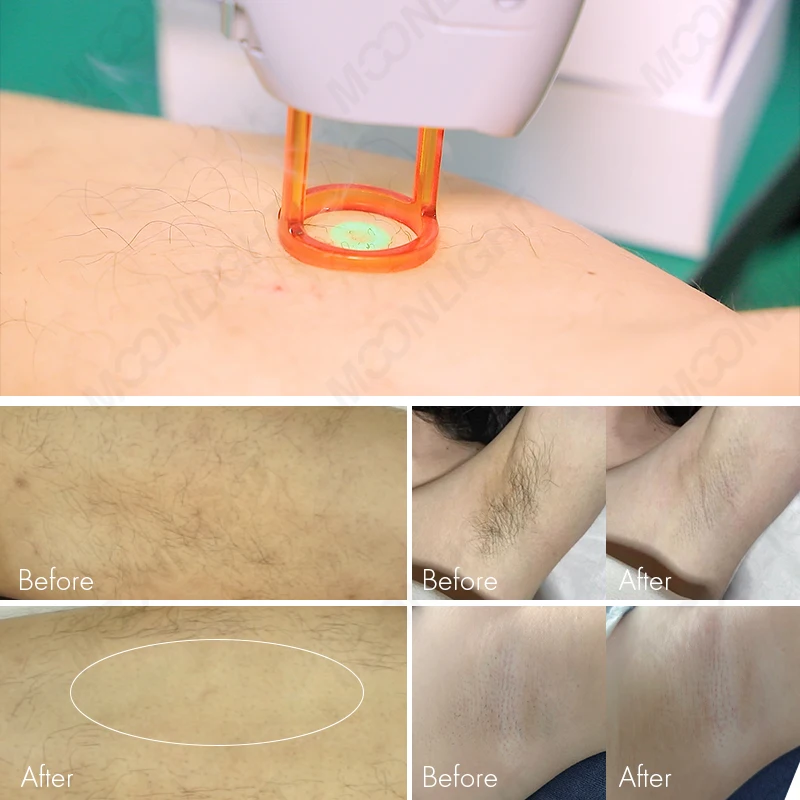 gentle nd-yag 1064nm 755nm deka motus ax alexandrite max pro laser hair removal apogee 755 2024 element cooling machine