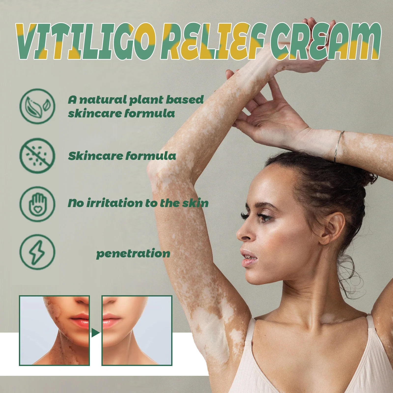 hot sale vitiligo cream white spot and vitiligo treatment skin care topical cream