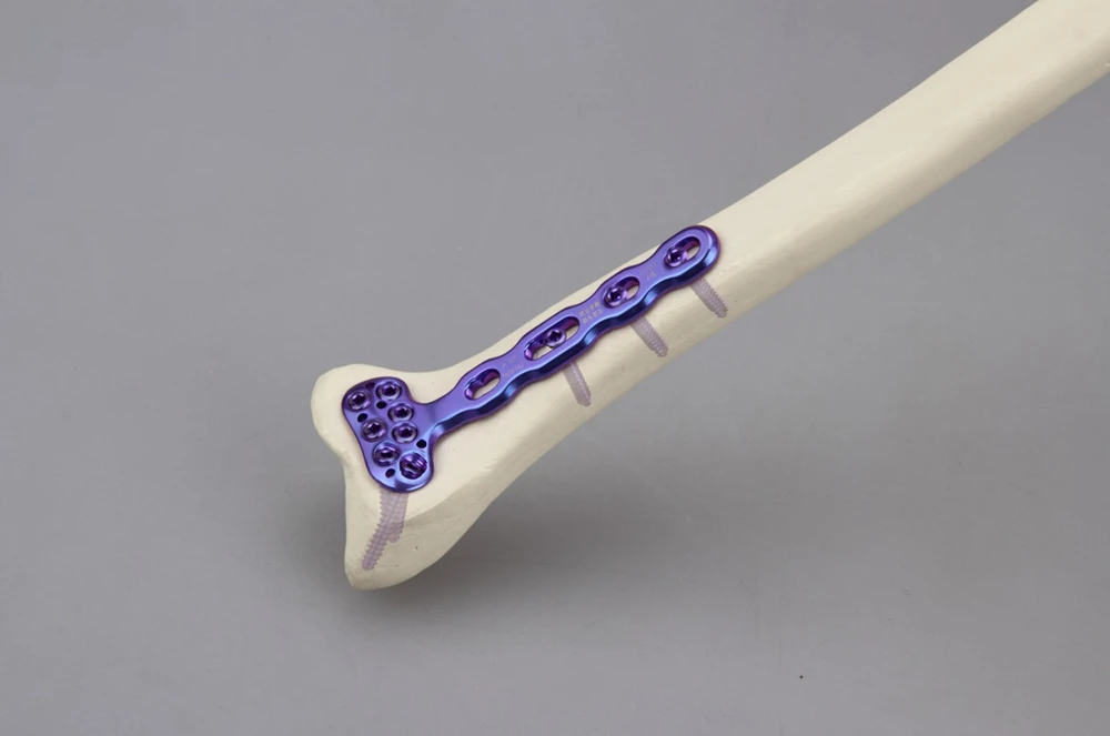 3.0 series titanium distal volar dorsal orthopedic locking plate and screw for bone trauma