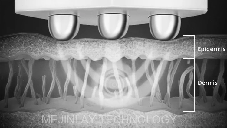 popular deep wrinkle tripolar rf face lifting tripolar radio frequency for sale