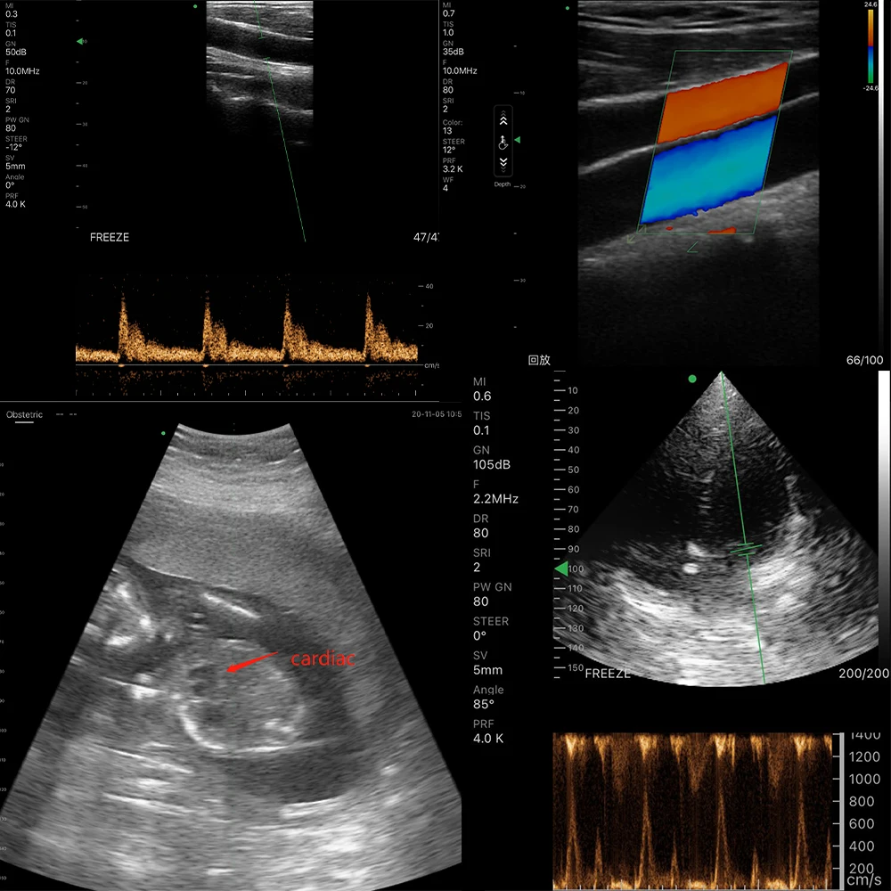 Suresult C10QT For Maternal And Child Health: Cardiac Ultrasound Probe Scanner From Beijing Konted