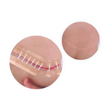 Продукты с 10 лет занимается исследованиями и разработкой и большой опыт в области раны застежка-молния и застежка-молния, подарочный набор для медицинская Регулируемая кожи