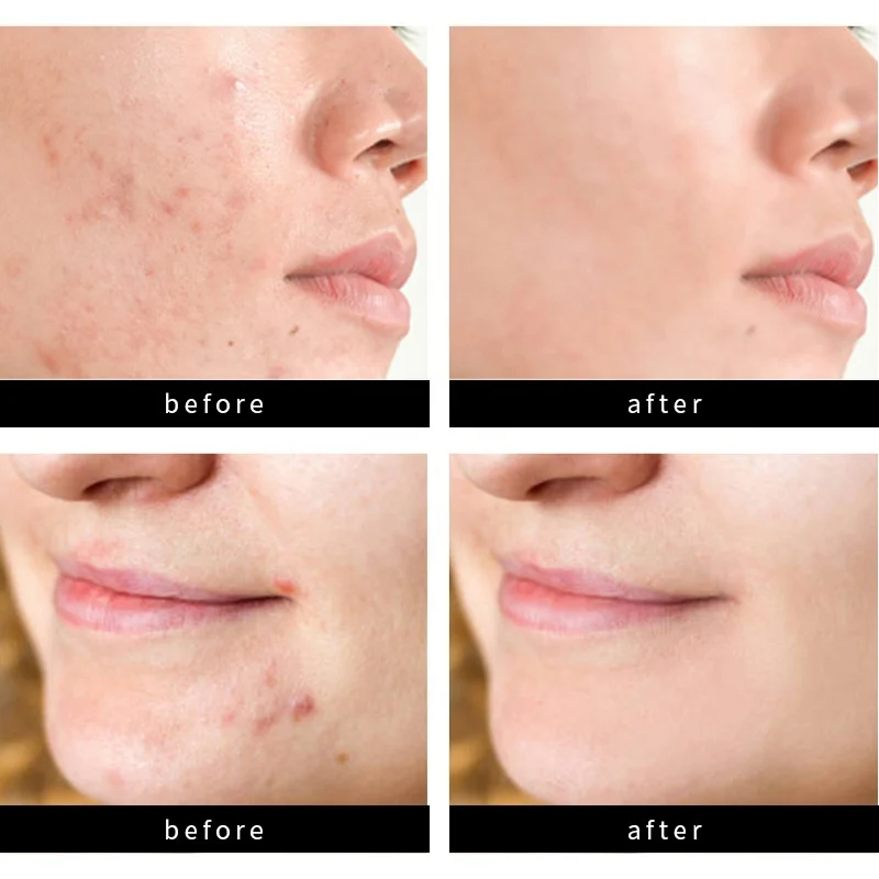 Skincare Manufacturer Invisible Hydrocolloid Acne Patches OEM Logo Korea Acne Patch Custom Large Circle Small Circle Acne Patch