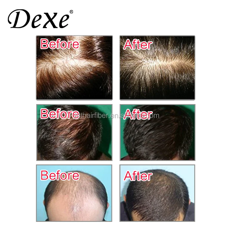 DEXE anti hair loss shampoo herbal shampoo