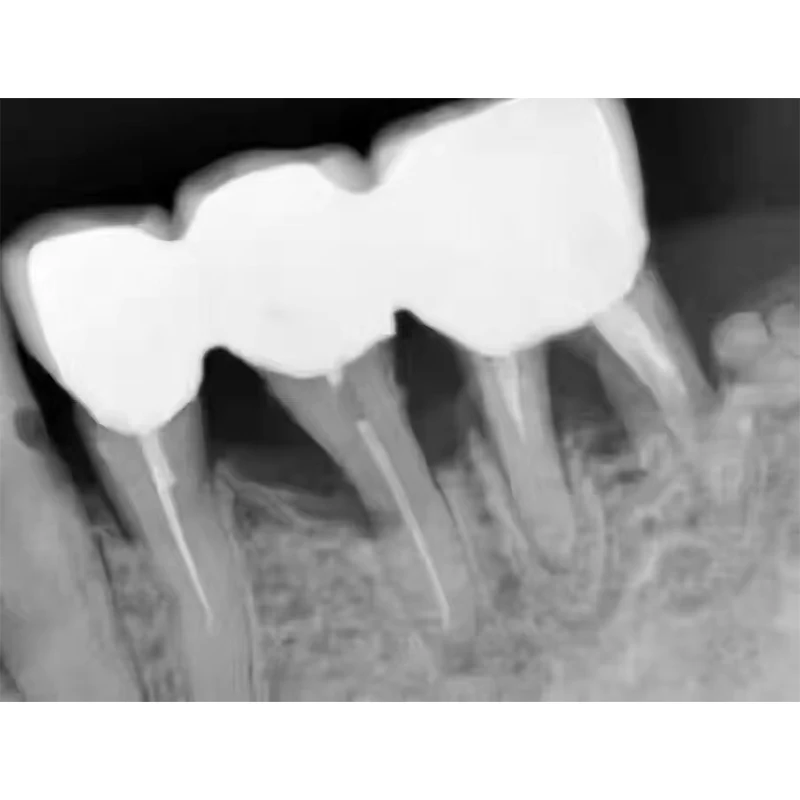 High Frequency Portable Dental X-ray Machine