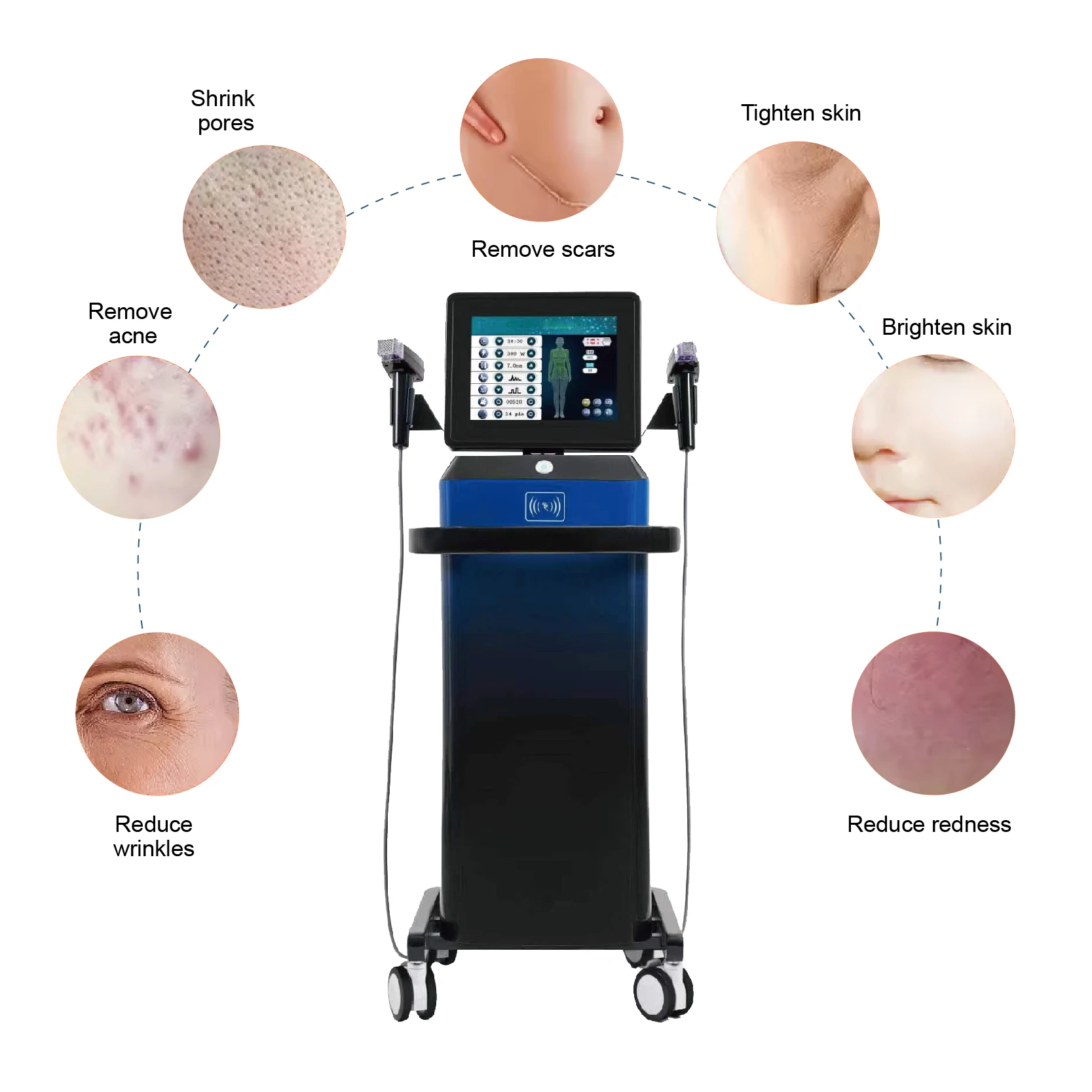 rf fractional microneedling stretch mark removal Radio frequency fractional rf microneedle face lift machine