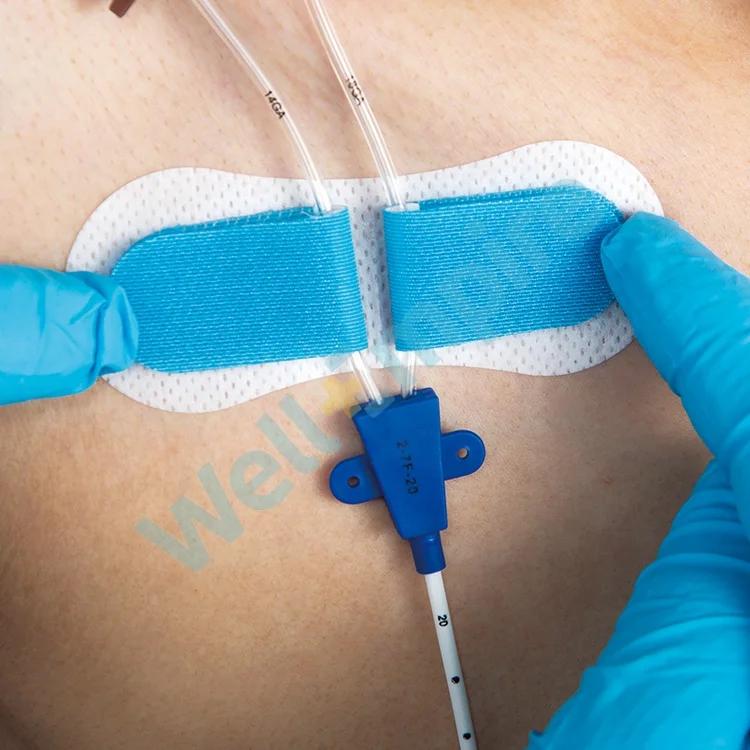 
G7 Foley Dressing Epidural Methods Umbilical Catheter Fixation 