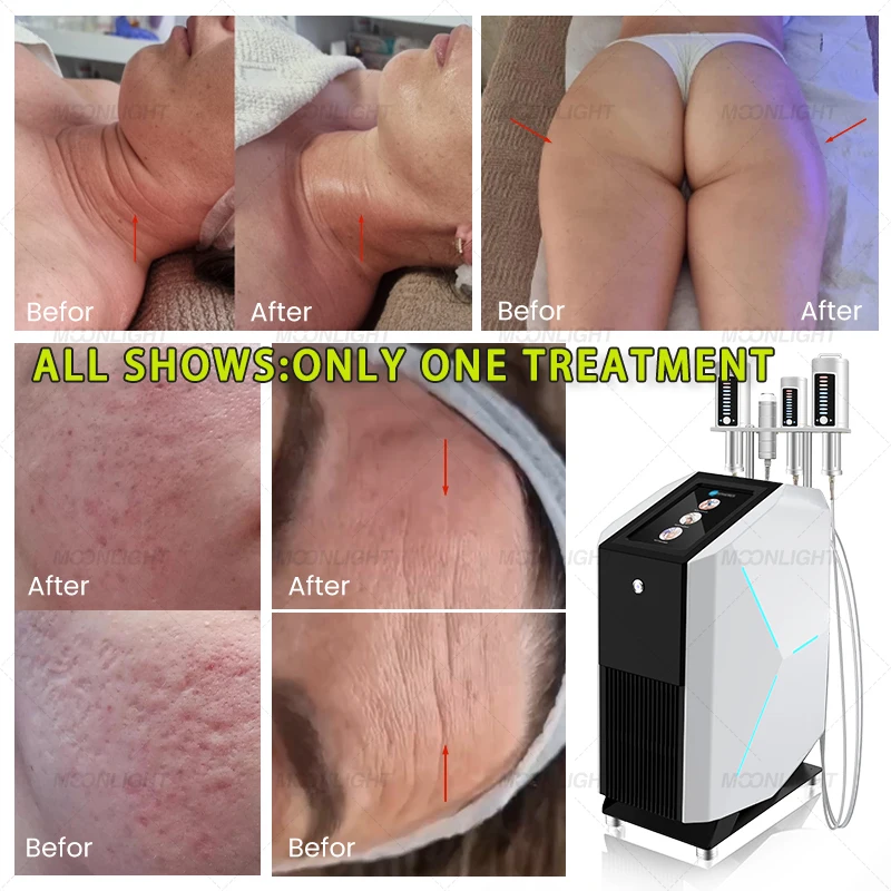 Pressure Sensitive Inner Ball Roller Facial Electro Full Body Lymphatic Drainage Pressotherapy Frequency Machine Sale