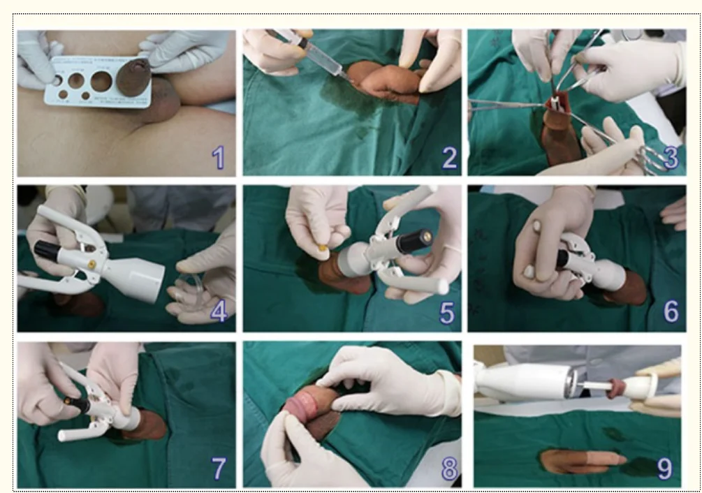 Good Price Disposable Circumcision Stapler For Male Adult Surgical Circumcision Device For Aldut And Children