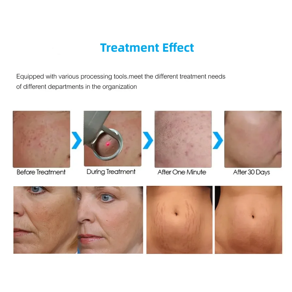 asthetice machine price marks removal co2 fractional laser for sale mini fractional co2 laser skin resurfacing machine