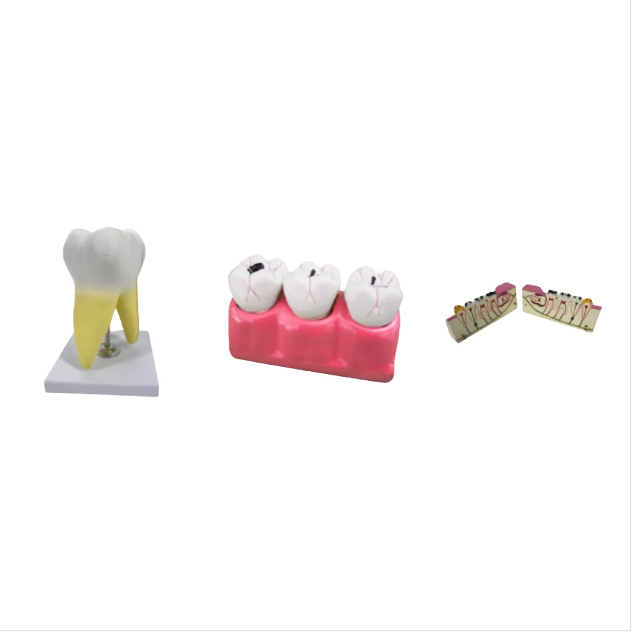 ADA Medical science magnified model of molars and caries decomposition model with tooth and model of root caries lesions