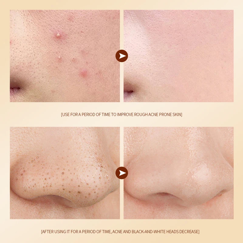 SADOER Private Label Colloidal Sulfur Acne Removing Essence Aloe Vera Tender Smooth Skin Care Serum Wholesale Beauty Products