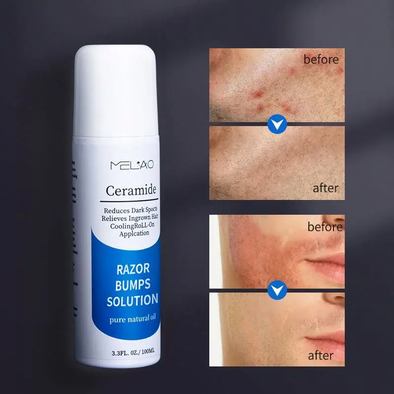 oem Roll On Solution Razor Bump Treatment After Shave Serum For Men And Women
